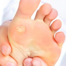 cura_especializada_clinica_ulcera_ivei_cadiz
