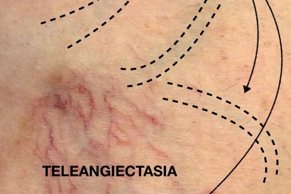 Teleangiectasia-y-variculas-600x1024