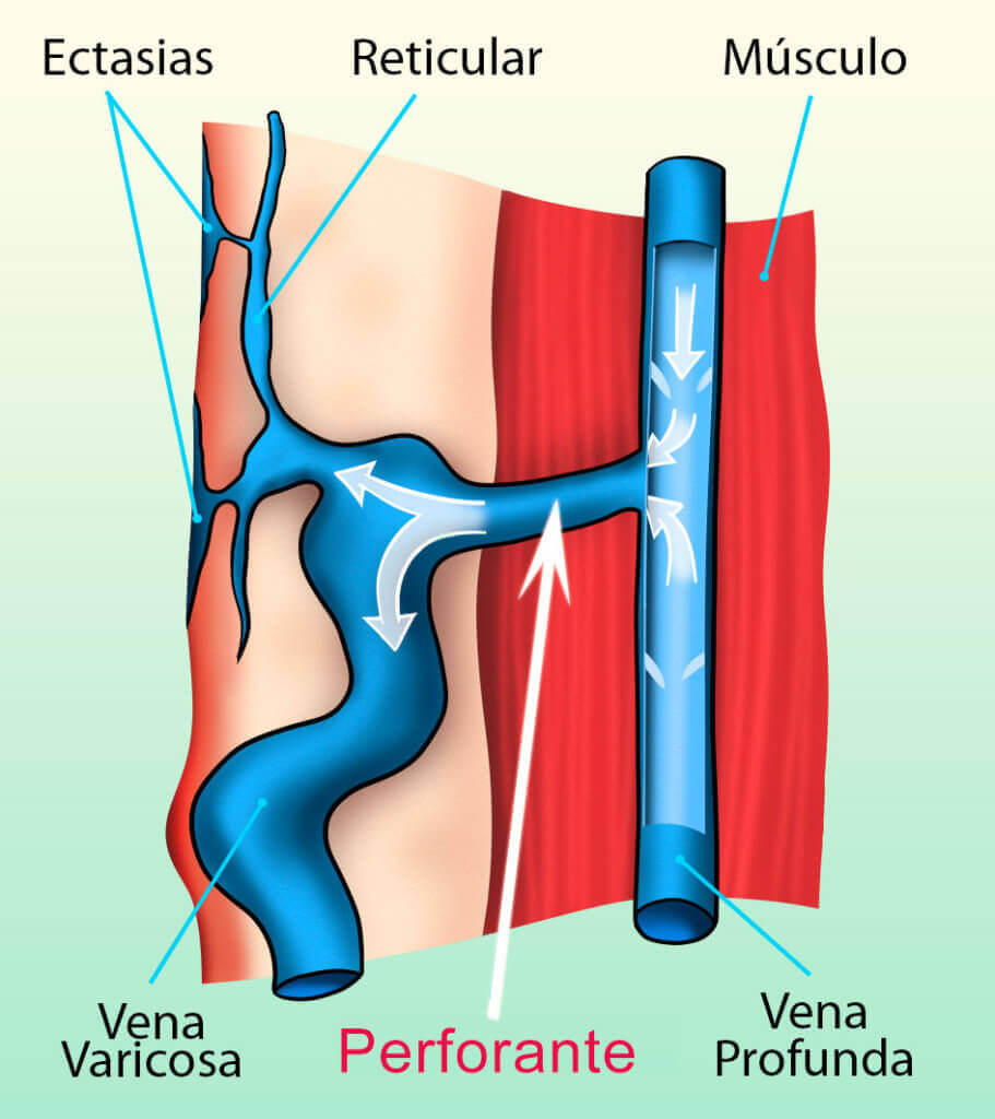 vene perforante
